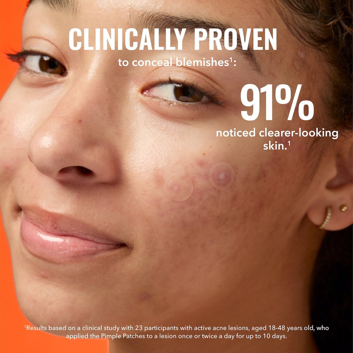 pimple-patches-m5 zb_p.jpg