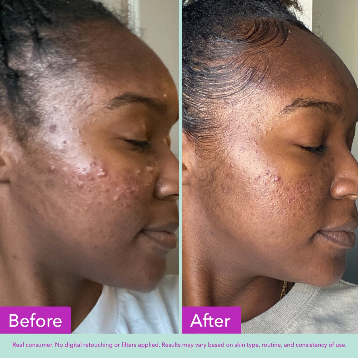 acne-foaming-cleanser-d9 zb_p.jpg